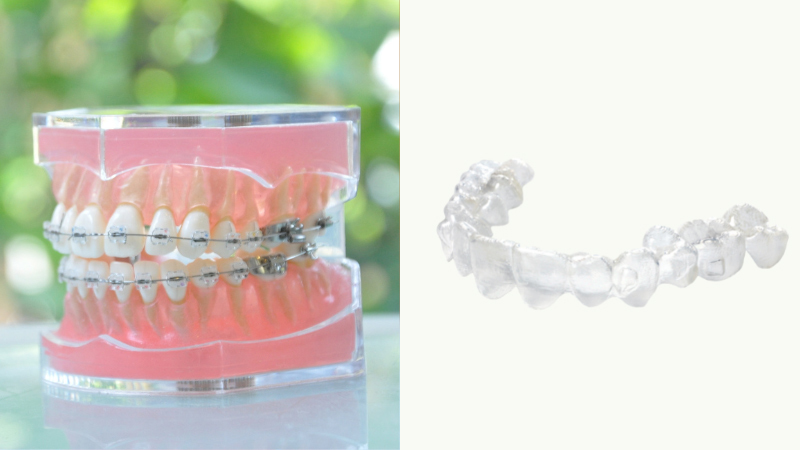 ワイヤー矯正とマウスピース矯正- 熊本市矯正歯科相談室