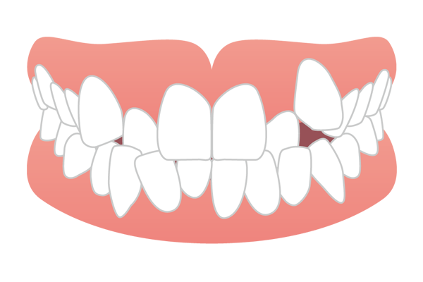 犬歯が歯列から飛び出している八重歯のイラスト