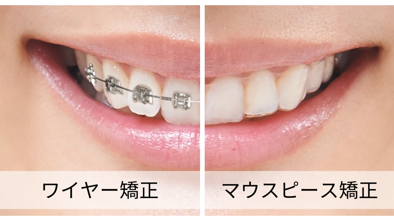 ワイヤー矯正とマウスピース矯正の装置