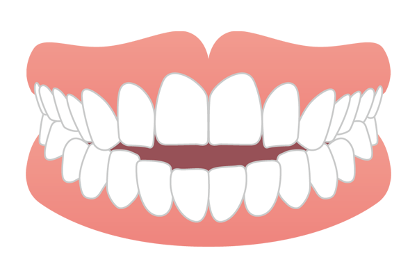 前歯が噛み合わず奥歯だけで噛んでしまう開咬（オープンバイト）のイラスト