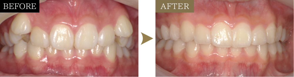 八重歯の治療前後比較写真（正面）