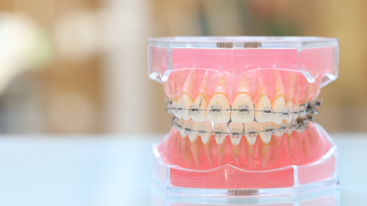 ワイヤー矯正装置を装着した口元