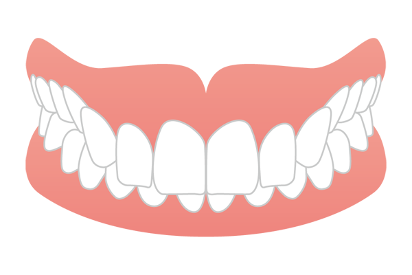 噛み合わせが通常より深い過蓋咬合（ディープバイト）のイラスト