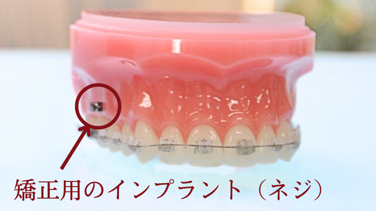 インプラント矯正について解説するページのリンク