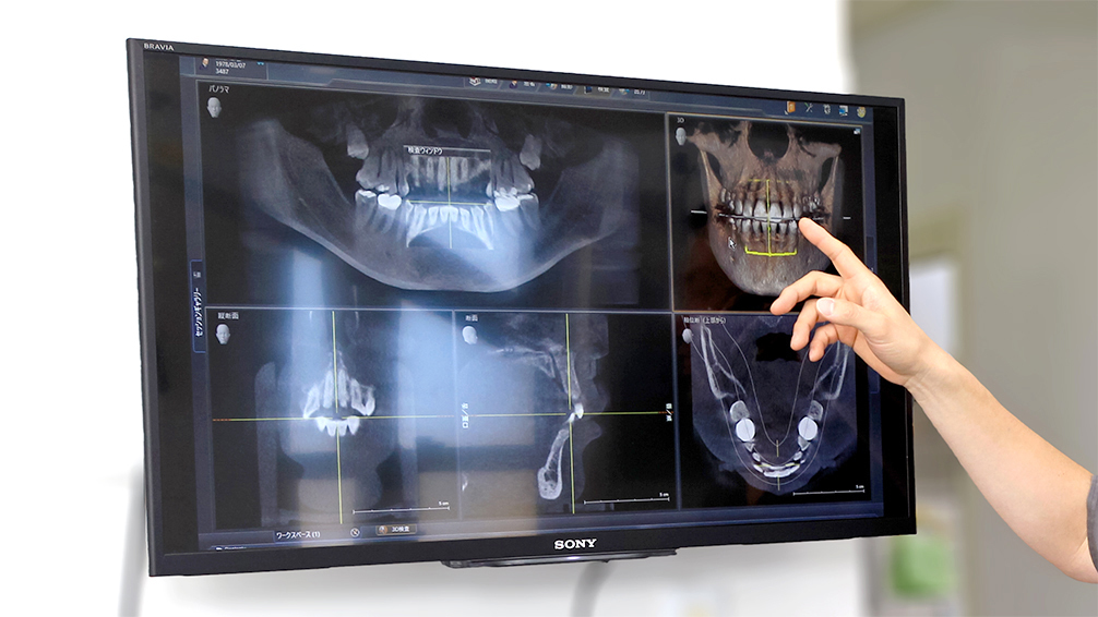 歯並びのシミュレーション画像