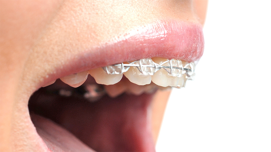 前歯に部分的なワイヤー矯正装置を装着した口元