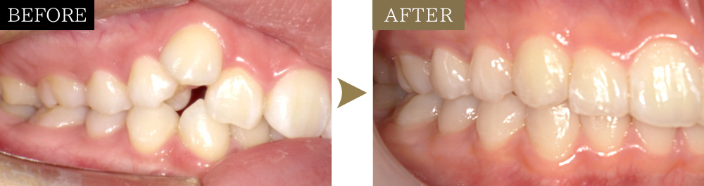 八重歯と叢生をマウスピース矯正で改善した治療前後の比較写真（側方面）